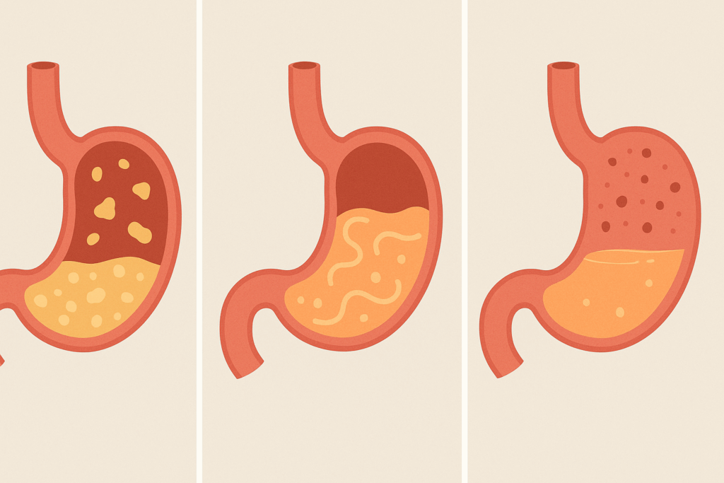 Why Do I Feel Full So Quickly? Understanding the Causes of Early Satiety and What It Could Mean for Your Digestive Health 3 Medical illustration comparing gastroparesis, functional dyspepsia, and gastritis to explain Why Do I Feel Full So Quickly